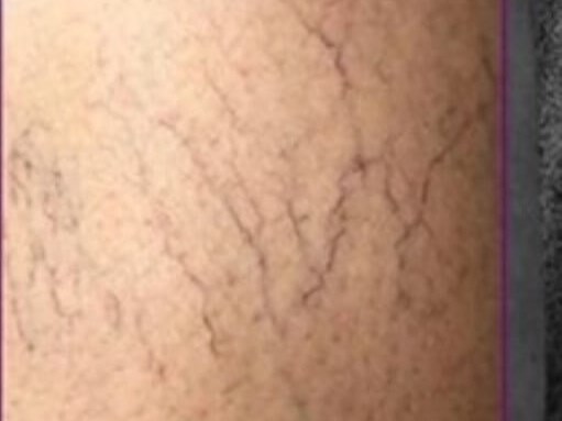 Patient's leg with visible spider veins before laser vein removal treatment in Andover, MA