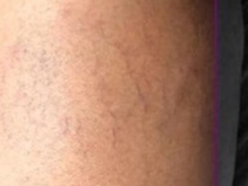 Patient's leg after laser vein removal treatment in Andover, MA