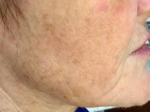 IPL – before