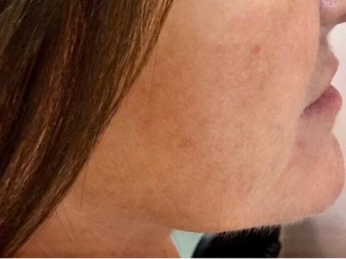 IPL – after