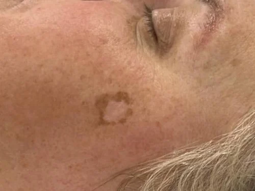 IPL – before