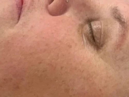 IPL – after