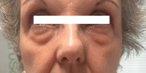 Light Eyes Ultra – before