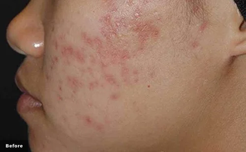 IPL – before