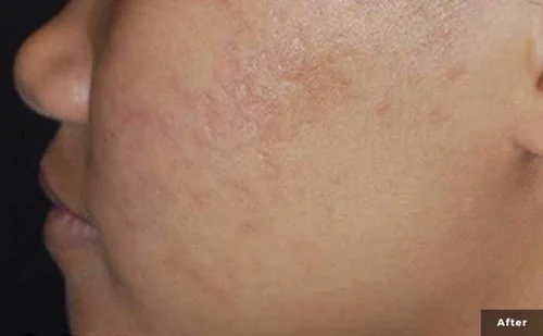 IPL – after
