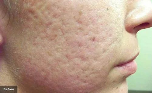 IPL – before