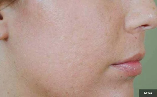 IPL – after