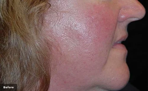 IPL – before