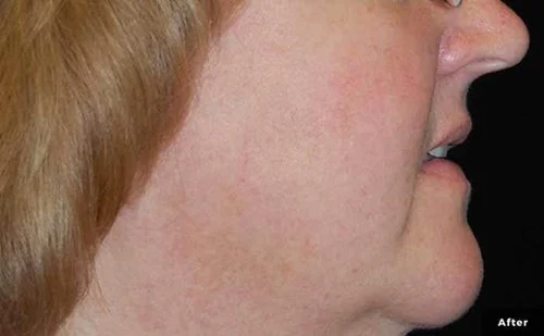 IPL – after